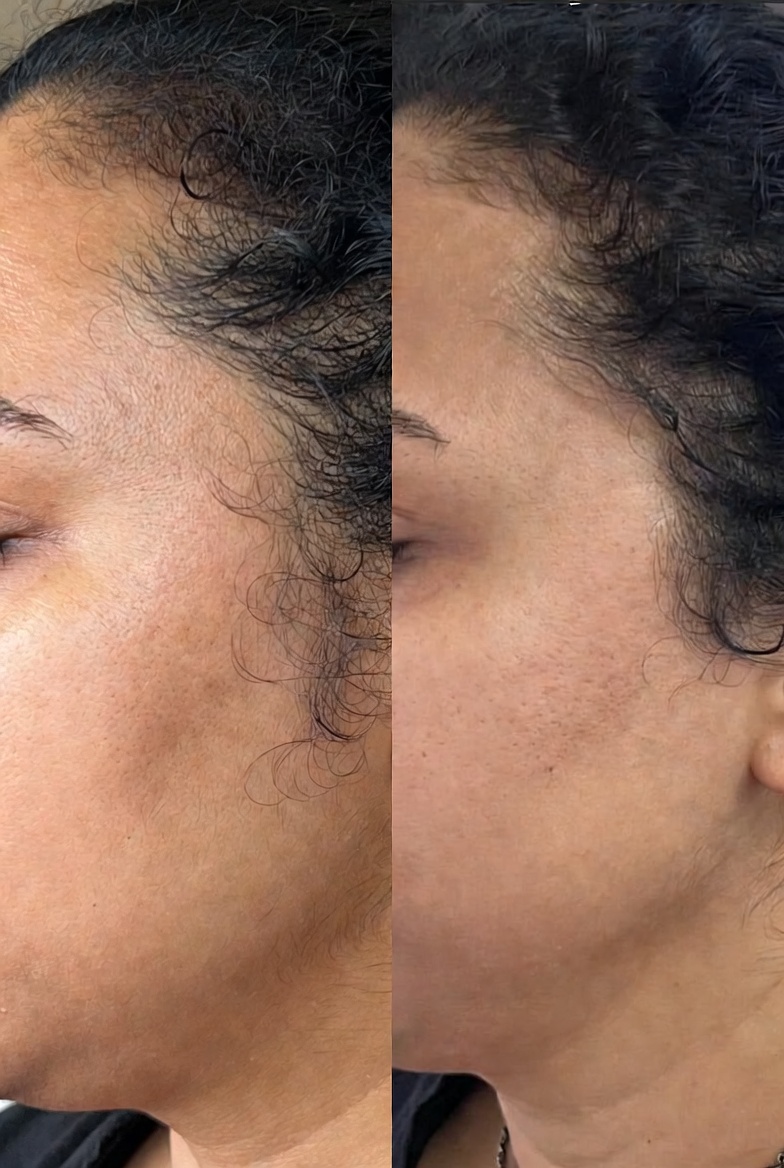 Hair Removal - Female - Before