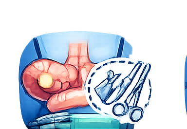Appendix Surgery